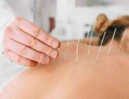 Acupuncture needles